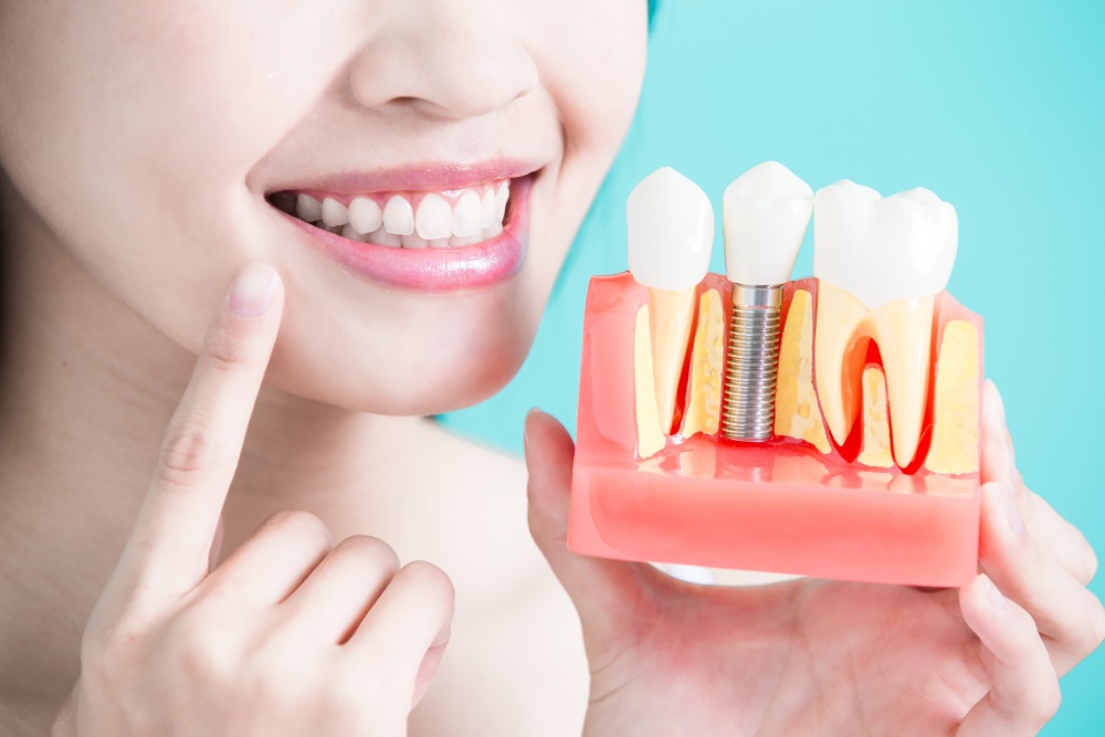 Dental Implant Crown and Jaw Model