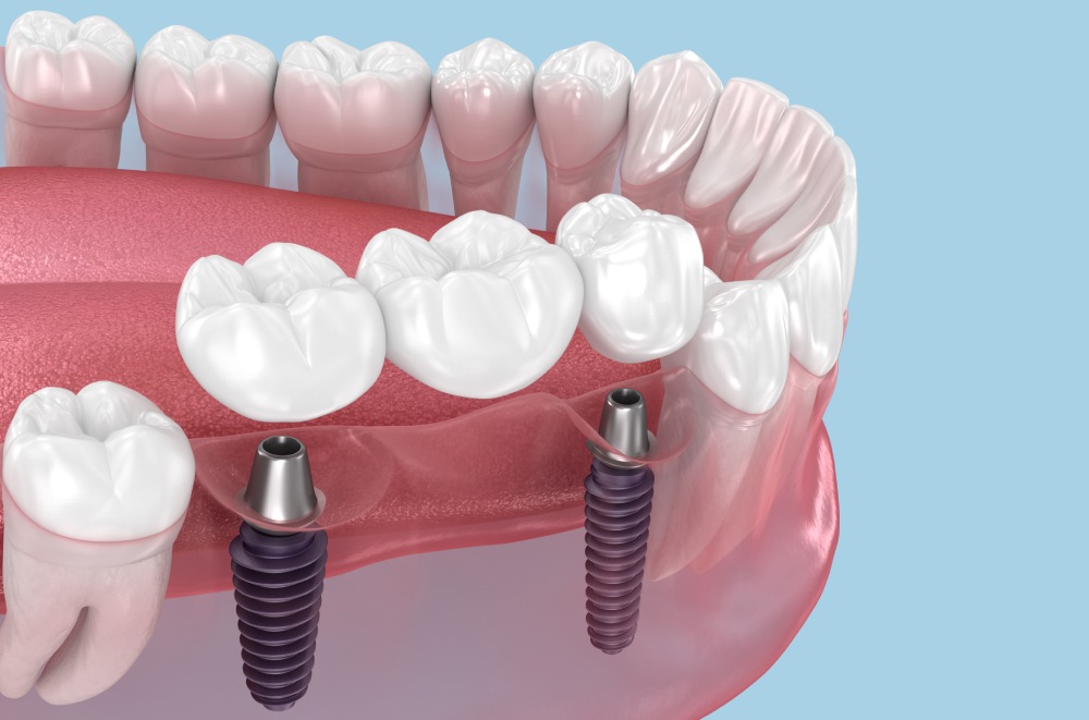 Implant-Supported Bridge Dental Restoration